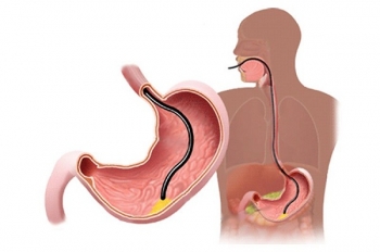 Cần nhịn ăn bao lâu trước khi thực hiện nội soi dạ dày?