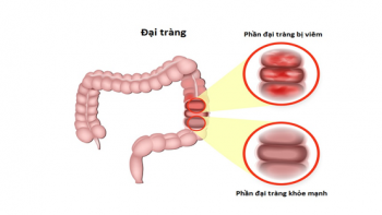 VIÊM ĐẠI TRÀNG CẤP TÍNH LÀ GÌ? | LỜI CẢNH BÁO ĐƯỜNG RUỘT BỊ NHIỄM KHUẨN